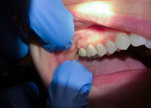 Best Walk-In Emergency Dentist in Herculaneum, MO